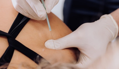 Dry needling - medicinska akupunktura
